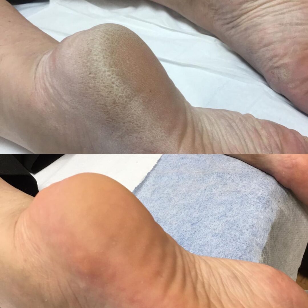 Antes e depois de Plástica dos Pés