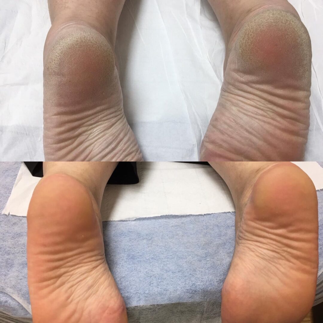 Antes e depois de aplicação da técnica